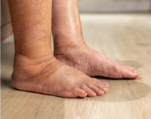 Lymphatic Flow: Keeping Things Moving to Reduce Swelling